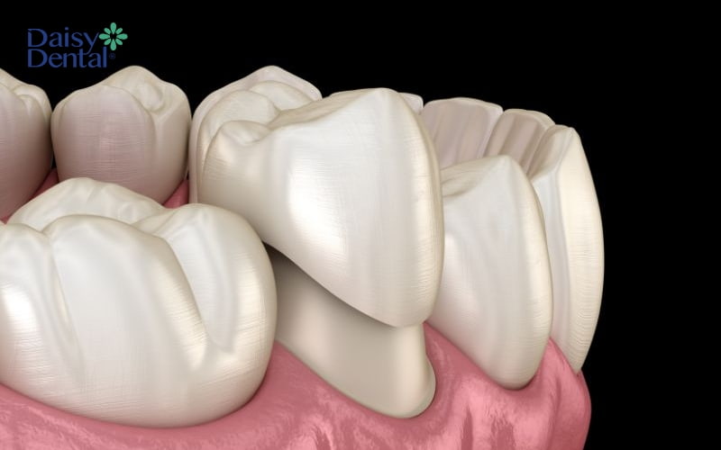 Bọc răng sứ sẽ hạn chế tình trạng tác nhân kích thích gây ê buốt răng