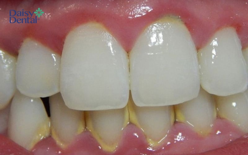 Cao răng bám lâu ngày sẽ dẫn đến tình trạng ê buốt răng khi uống nước