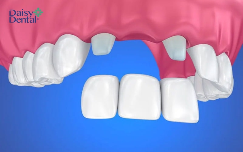 Cầu răng sứ là một trong những cách phục hình được nhiều người lựa chọn