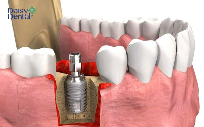 Kỹ thuật nâng xoang hàm hở được dùng cho trường hợp mất răng lâu năm