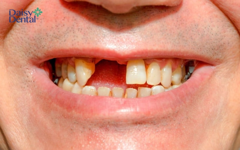 Mất 2 răng cửa ảnh hưởng nghiêm trọng đến tính thẩm mỹ của hàm răng