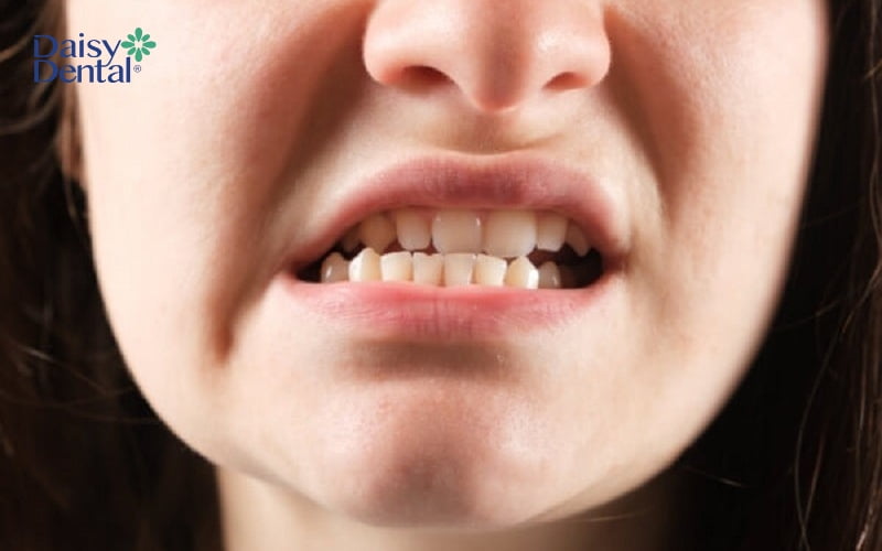 Một số trường hợp khuôn mặt mất cân đối do thiếu mất răng trên cung hàm