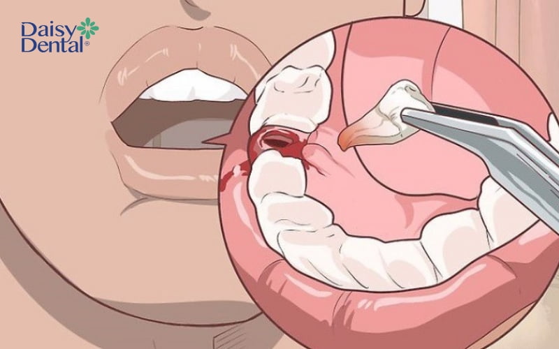 Răng là vị trí nhạy cảm nên sẽ rất dễ chảy máu khi có tác động vào