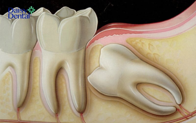 Tổn thương các dây thần kinh răng cũng khiến người bệnh đau nhức dữ dội