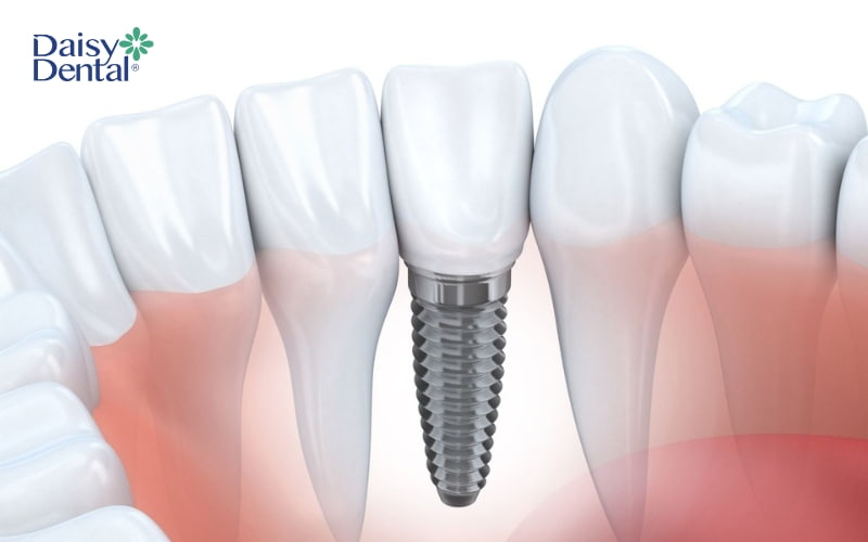 Trồng răng Implant được xem là giải pháp phục hình răng tối ưu nhất hiện nay