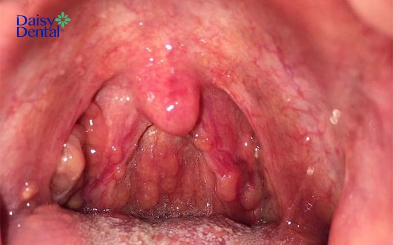 Viêm họng hạt là bệnh lý đường hô hấp thường gặp