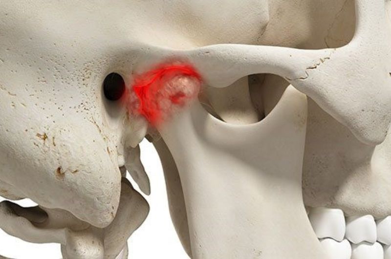 Khớp hàm bị viêm dẫn đến đau nhức, đồng thời làm giảm khả năng ăn nhai, giao tiếp.