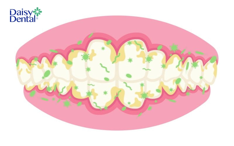 Vôi răng không chỉ gây mất thẩm mỹ mà còn ảnh hưởng đến sức khỏe răng miệng