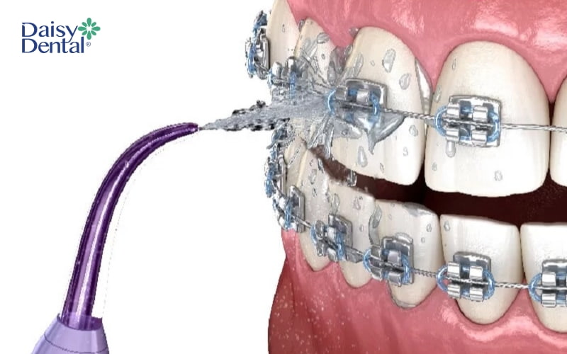 Đây là thiết bị vệ sinh răng miệng cần thiết cho người niềng răng