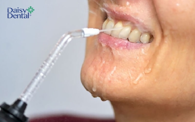 Áp lực nước chưa được chỉnh phù hợp mà quá mạnh dẫn đến nướu bị tổn thương và chảy máu