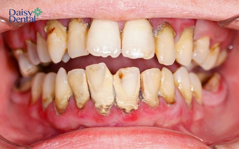 Cao răng độ 4 có thể làm viêm nướu răng