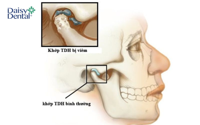 Viêm khớp thái dương hàm là một trong những nguyên nhân dẫn đến tình trạng này