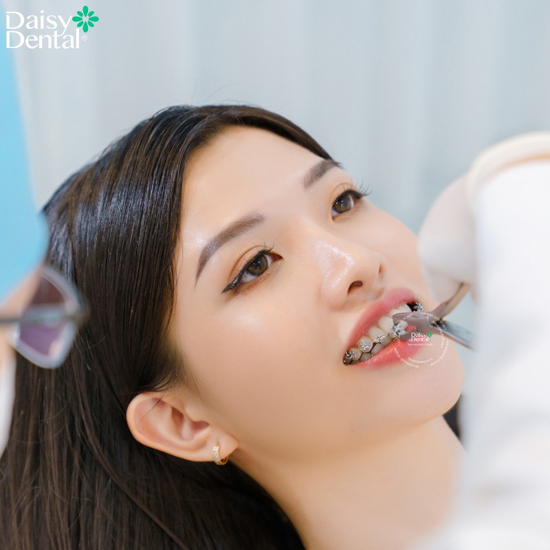 Sự thay đổi ngoạn mục trước và sau khi tháo niềng răng của các bạn sinh viên tại DAISY DENTAL