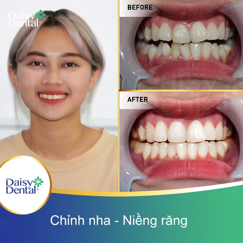Sự thay đổi ngoạn mục trước và sau khi tháo niềng răng của các bạn sinh viên tại DAISY DENTAL