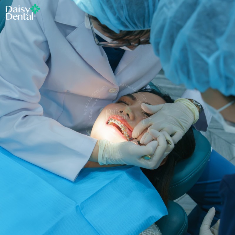 Sự thay đổi ngoạn mục trước và sau khi tháo niềng răng của các bạn sinh viên tại DAISY DENTAL