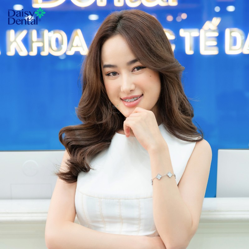 Sự thay đổi ngoạn mục trước và sau khi tháo niềng răng của các bạn sinh viên tại DAISY DENTAL