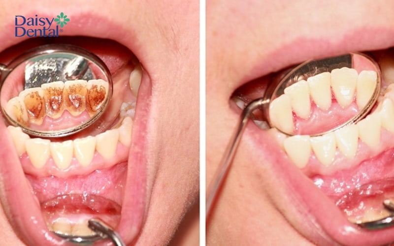 Lấy cao răng định kỳ 6 tháng/lần