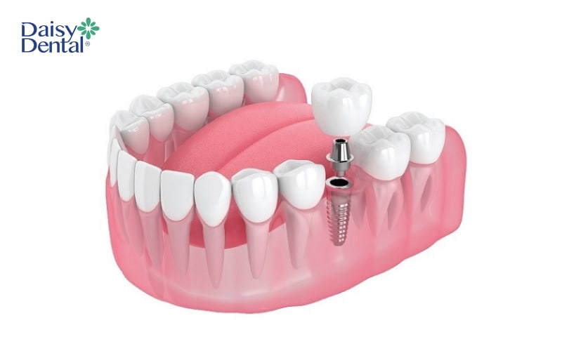 Cấy ghép Implant - Giải pháp phục hình răng mất hiệu quả