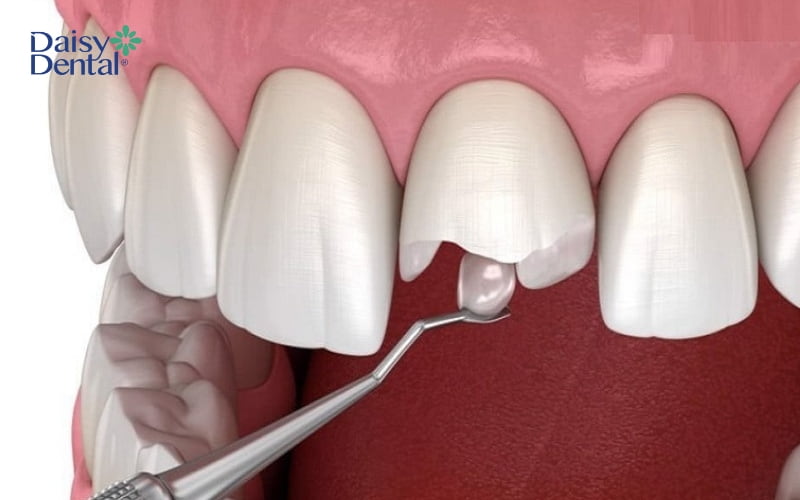 Bác sĩ có thể chỉ định trám răng để phục hình răng bị mẻ