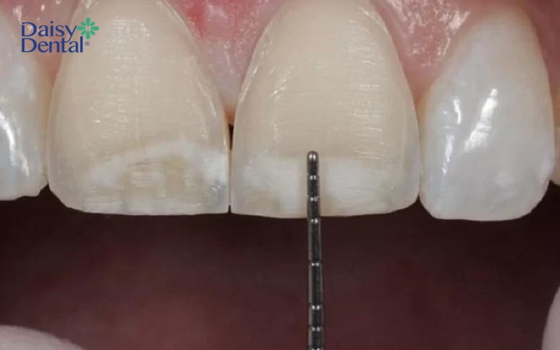 Nếu răng bị mẻ nhẹ, bác sĩ có thể mài nhẵn bề mặt để đảm bảo tính thẩm mỹ của răng