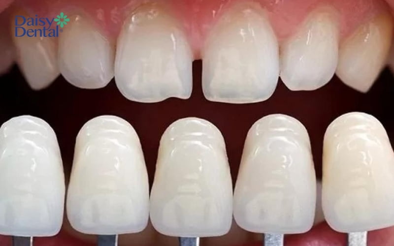 Người bệnh có thể bọc răng sứ để ngăn vi khuẩn tấn công vào buồng tủy