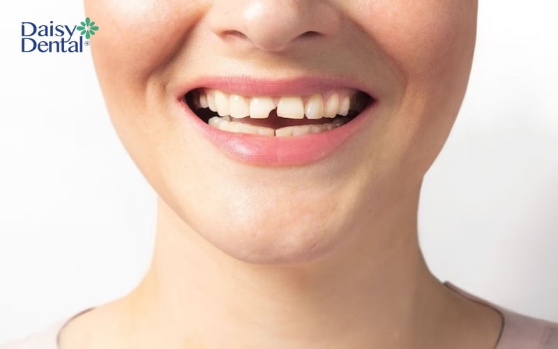 Răng cửa sẽ dễ bị mẻ nếu bạn có thói quen dùng răng để mở nắp chai, nắp hộp hoặc cắn đồ cứng