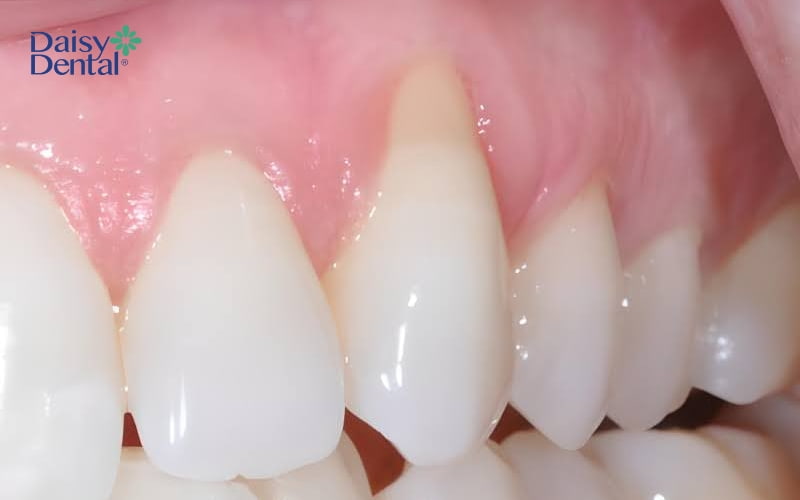 Răng số 3 dài hơn bình thường do lộ chân răng