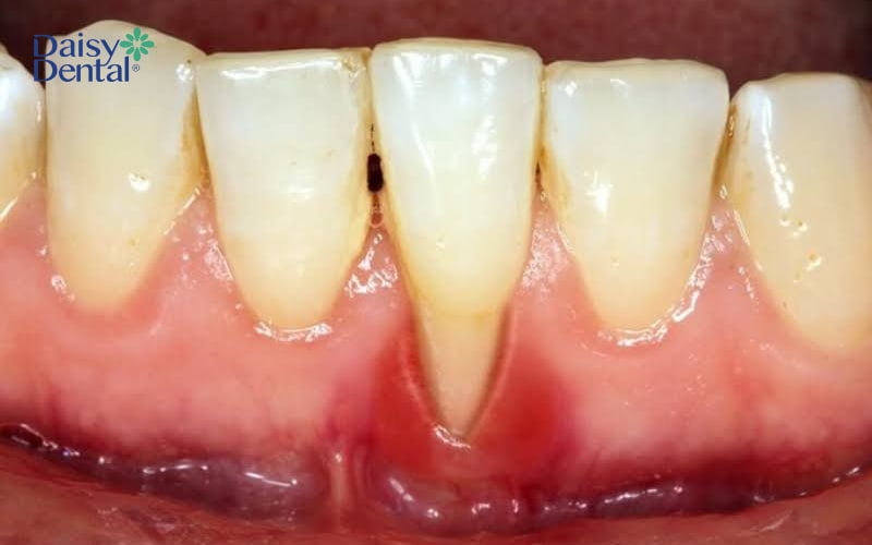 Viêm nướu là nguyên nhân hàng đầu dẫn đến tụt nướu, lộ chân răng