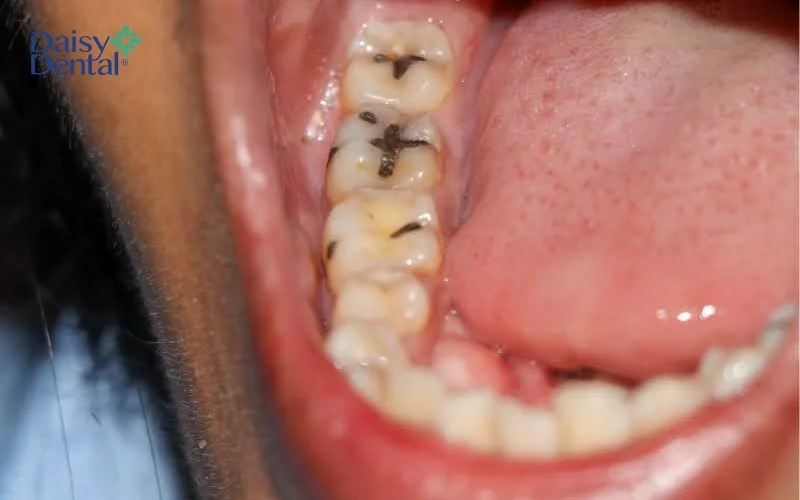 Vì có vị trí nằm sâu trong hàm nên răng số 7 rất dễ bị sâu