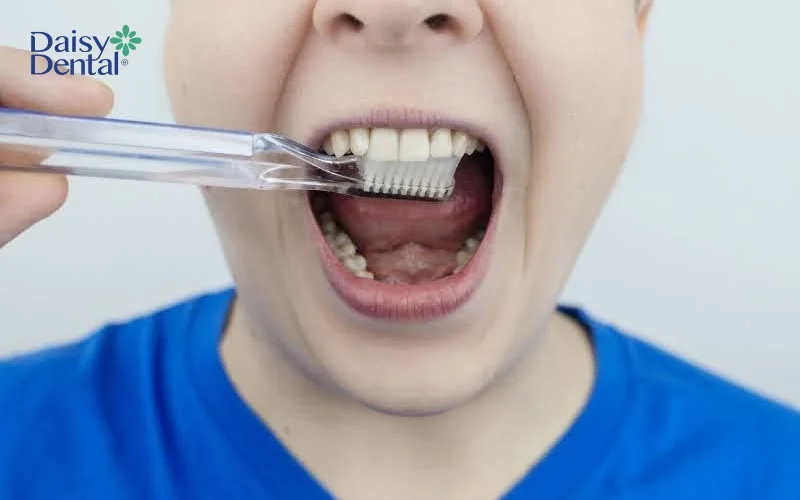 Vệ sinh răng miệng không hiệu quả dễ dẫn đến sâu răng