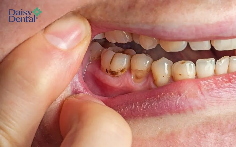 Nếu không điều trị sớm, sâu răng có thể lây lan sang răng bên cạnh