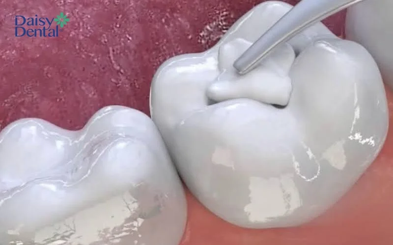 Bác sĩ có thể chỉ định trám răng để điều trị sâu răng