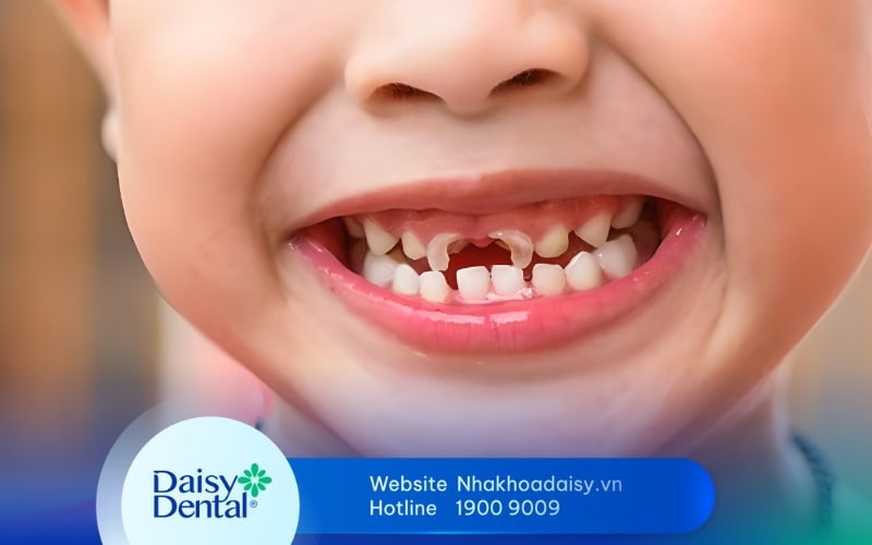 Trẻ 15 tháng bị mủn răng do đâu? Cách khắc phục hiệu quả