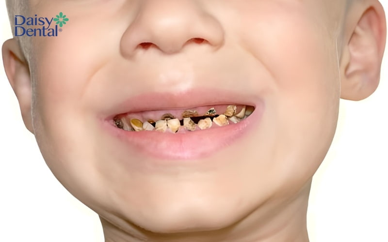 Tình trạng men răng bị phá hủy khiến cho răng bị mủn dần