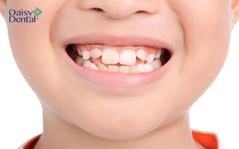 Răng vĩnh viễn có nguy cơ mọc lệch nếu răng sữa bị sâu vỡ, rụng sớm