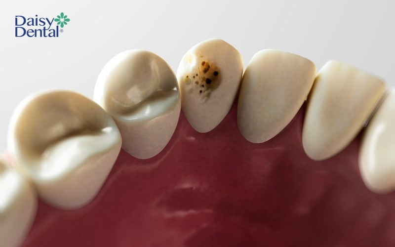 Gãy răng cũng là nguyên nhân dẫn đến sâu răng cũng như các bệnh lý răng miệng khác