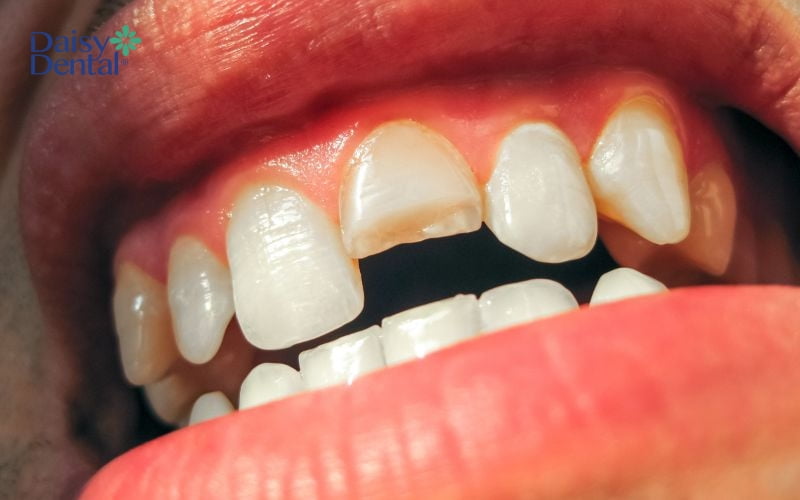 Gãy răng cửa làm mất thẩm mỹ nụ cười