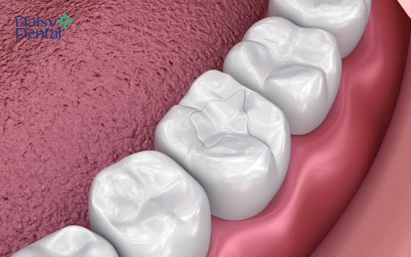 Trám răng là phương pháp phục hồi gãy răng với chi phí thấp