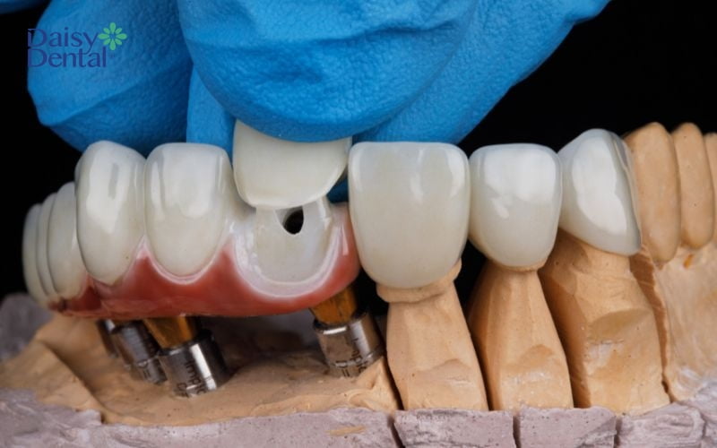 Bọc răng sứ giúp phục hình răng gãy hiệu quả, mang lại tự tin đối với những trường hợp gãy răng cửa