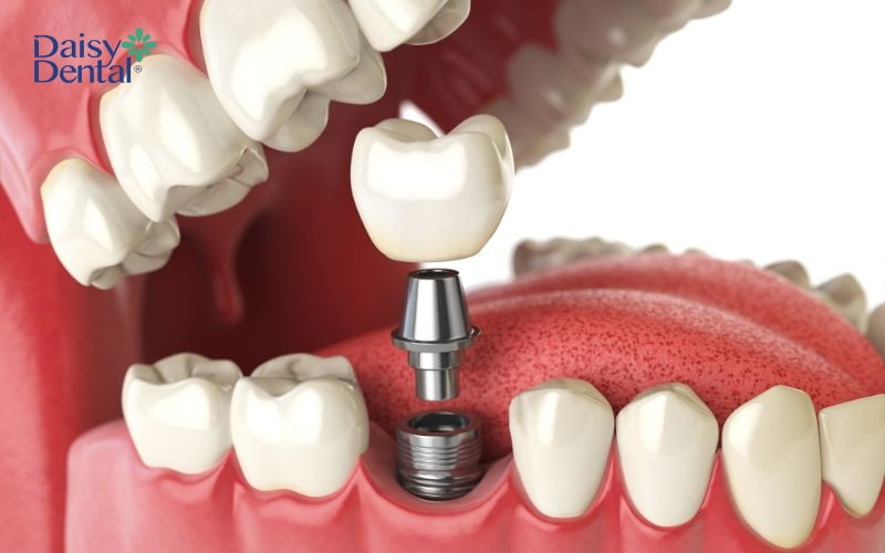 Trong các biện pháp khắc phục gãy răng, cấy ghép Implant là giải pháp tiên tiến, tối ưu nhất