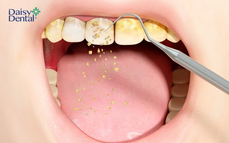 Loại bỏ mảng bám vôi răng sẽ giúp hơi thở dễ chịu hơn