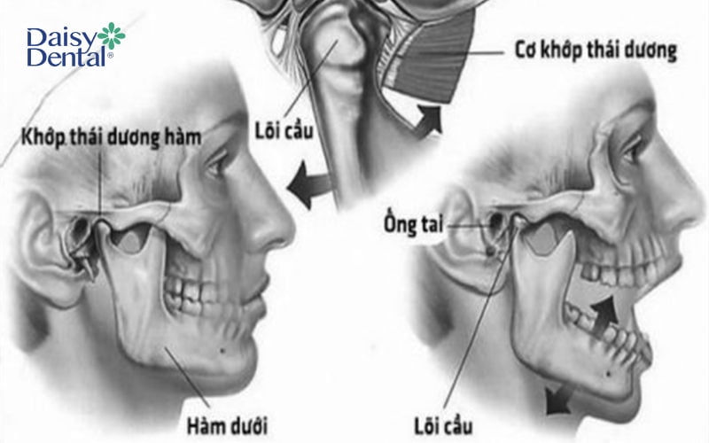 Rối loạn khớp thái dương hàm thường gây ra đau nhức vùng gần tai