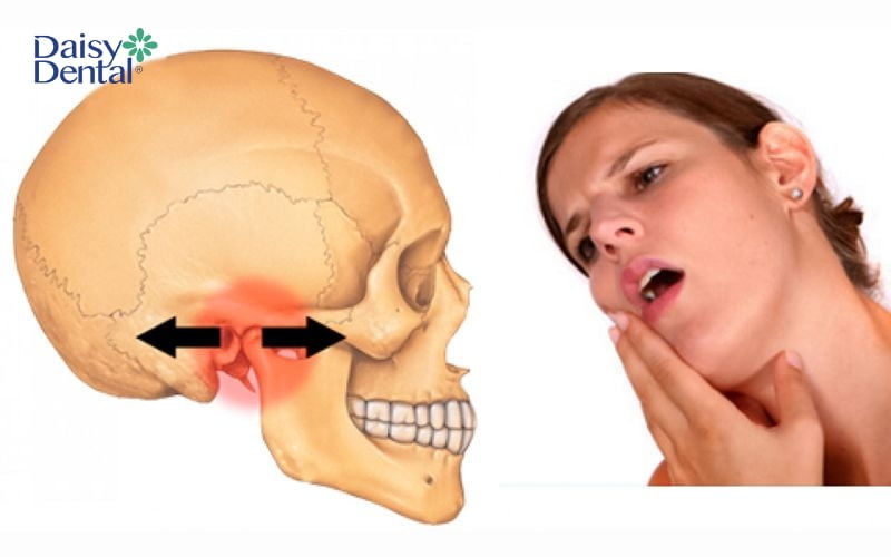 Sái quai hàm do ngủ sai tư thế, ăn nhai lệch bên,... và gây ra tình trạng đau mỏi hàm