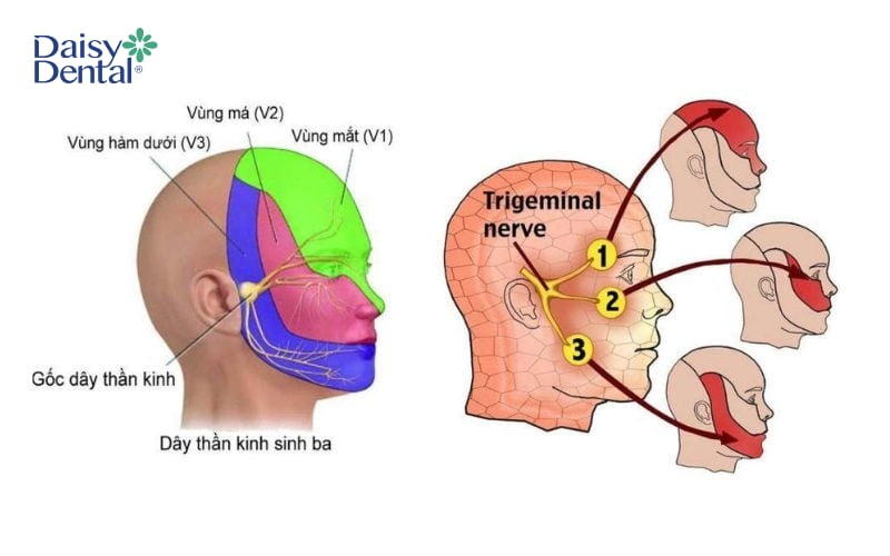 Tình trạng đau dây thần kinh sinh ba