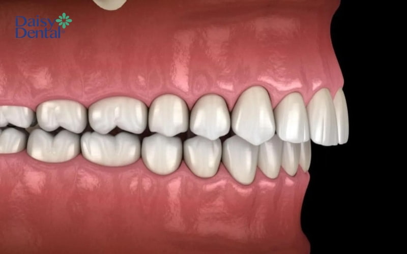 Phương pháp di xa thường được chỉ định cho các trường hợp hô, móm, khấp khểnh nặng