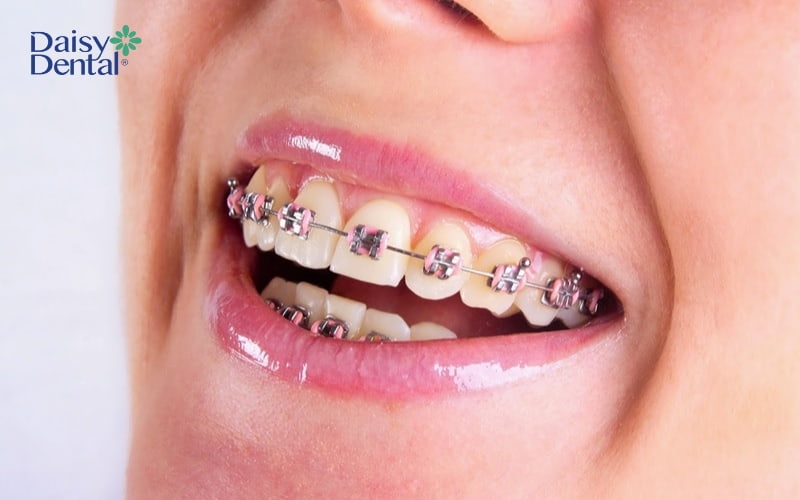 Sau khi thực hiện di xa thành công, răng sẽ trở nên đều đẹp hơn