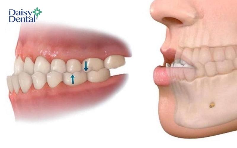Tùy vào mức độ hô, móm, khấp khểnh mà thời gian di xa cũng sẽ khác nhau