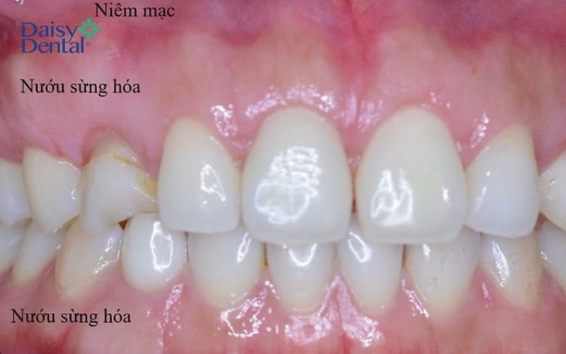 Tình trạng nướu sừng hóa