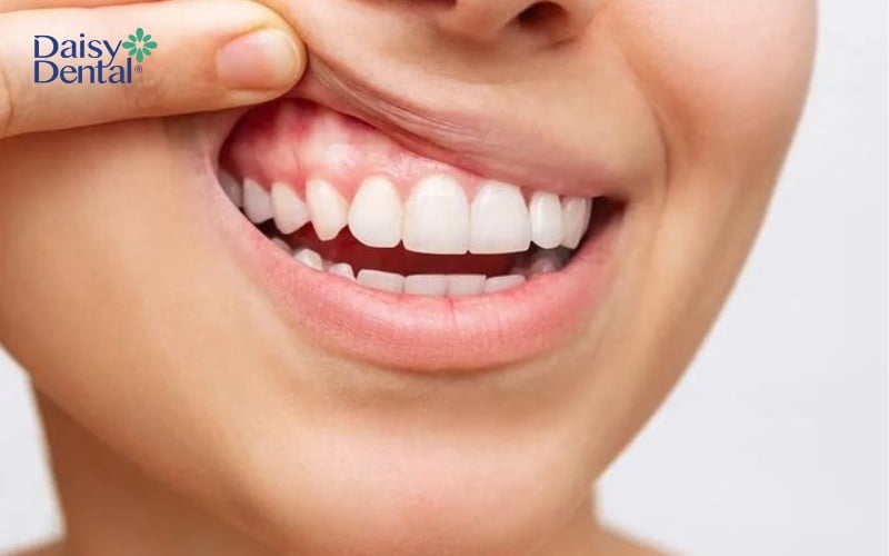 Nướu sừng hóa góp phần giúp bảo vệ răng khỏe mạnh