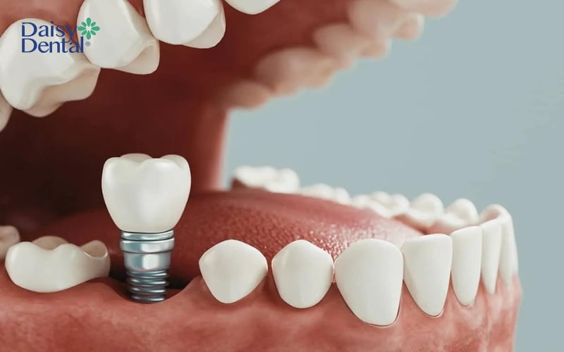 Nhờ có phần nướu này, vết thương sau khi cấy ghép Implant cũng sẽ lành nhanh hơn